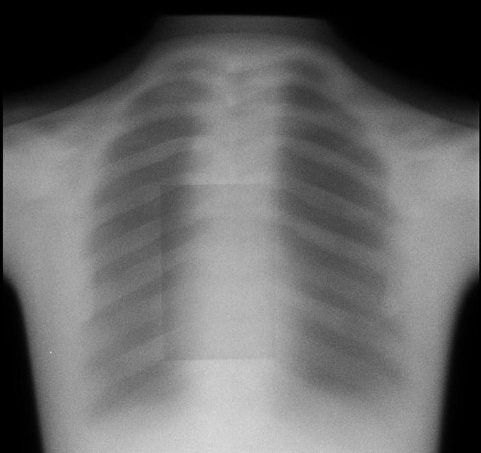 For both the lateral and the AP views, there are two separate sources of motion that could contribute to differences between the “pre” and “post” images: movement of the patient and the ovement of the spine and/or screws. The camera itself has preset positions for both views, with millimeter-level noise between separate images that can be effectively ignored. As the movements of the patient are extraneous, they introduce noise that makes it difficult to evaluate patient progress and diagnose any potential issues (e.g. pseudarthrosis) that may cause major health risks. As a result, a patient that may come in after their operation to diagnose why they haven’t seen the expected improvement may require additional x-rays which delay the process, which could result in any medical conditions worsening or potentially another operation being required.